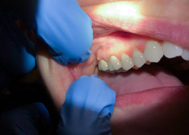 Best Emergency Root Canal Treatment in Towson, MD